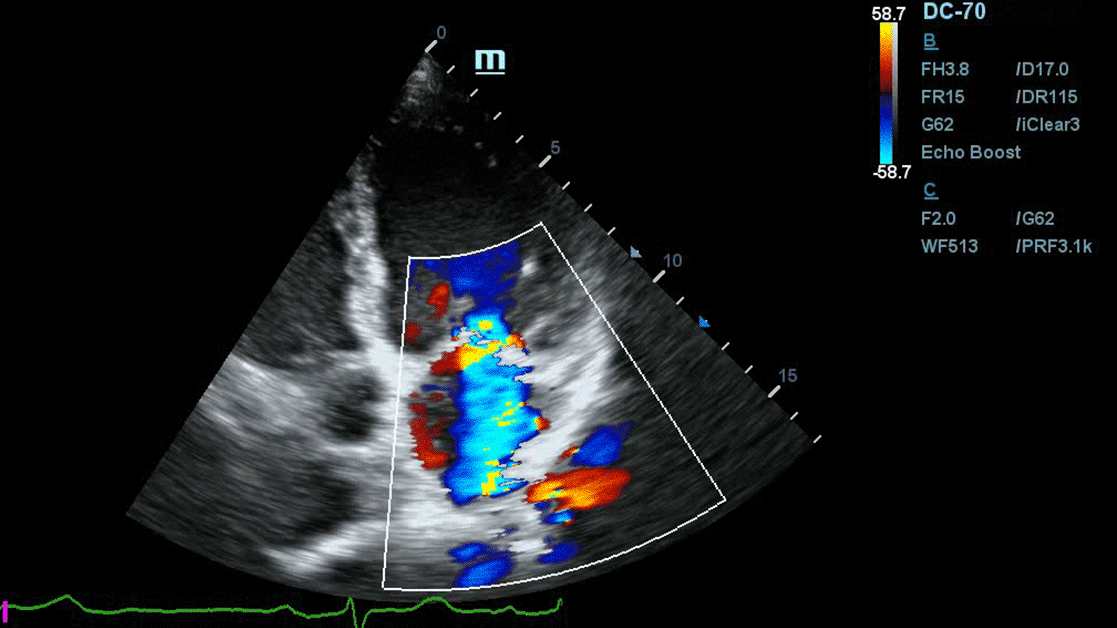 Echocardiography
